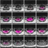 Hip MRI, framed. by Mary Ann Santin