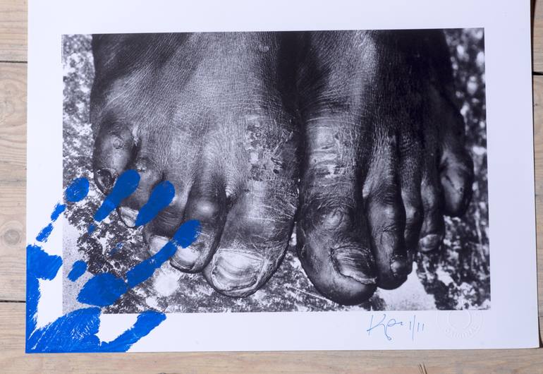 South African ‘Street Urchin’ (Black Child) Barefoot With Rat Bites. Cape Town, South Africa, 2009 - Limited Edition of 11