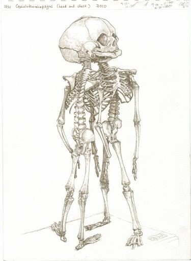 cephalothoracopagus foetal skeleton thumb