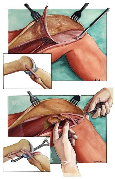 Anterior cruciate repair thumb