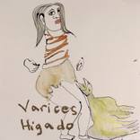 Varices/ Higado by Theresa  Anderson