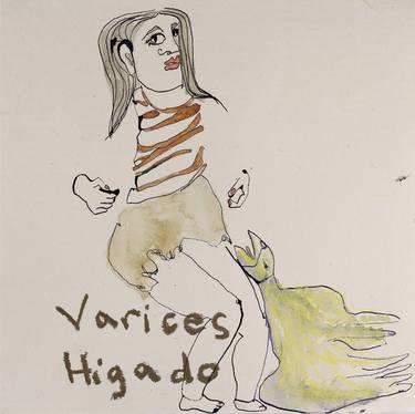 Varices/ Higado thumb