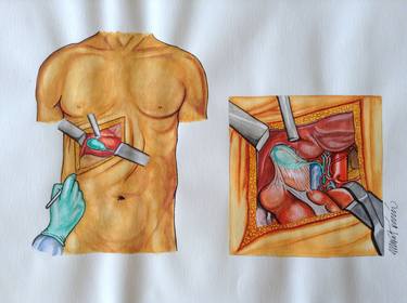 Surgery of gall bladder thumb